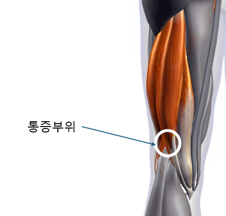 <174일 차, 3월 17일 화요일> 햄스트링 통증